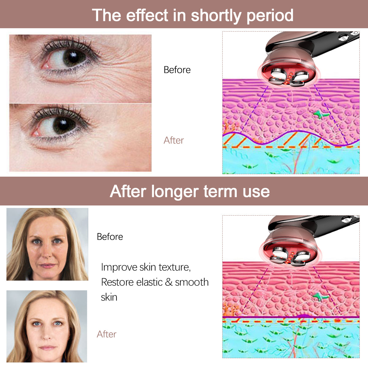 RF Face Lifting Wrinkle Removal Skin Tightening Machine